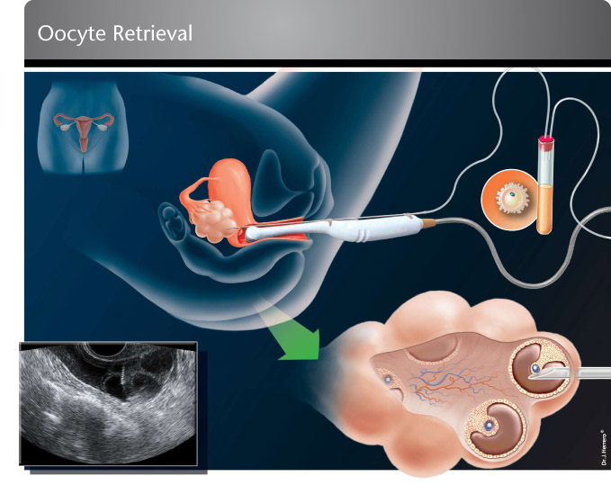 Tecniche di II e III livello: FIVET/ICSI, IMSI e prelievo testicolare